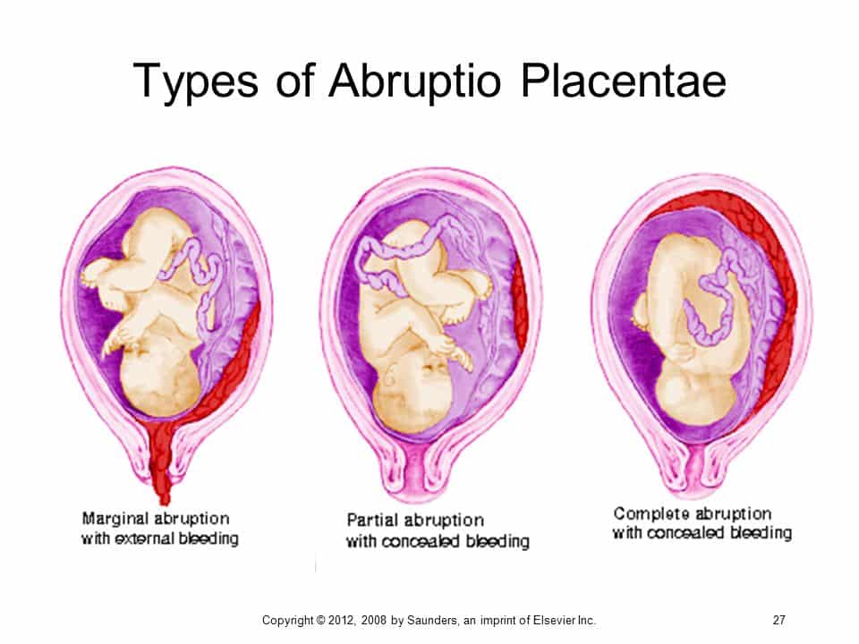 Medical diagram titled “Types of Abruptio Placentae”, showing marginal, partial and complete placental abruption