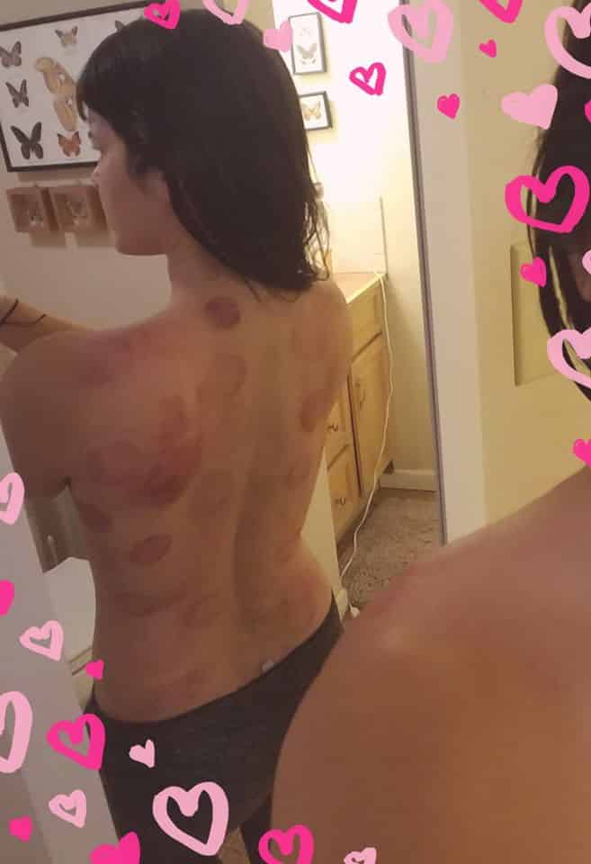 Mirror selfie showing round cupping marks across a back and shoulders, overlaid with drawn pink hearts
