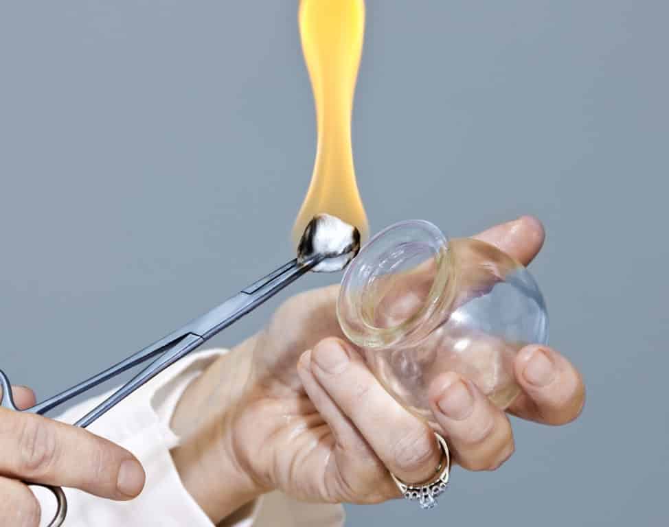 A practitioner holds a glass cup in one hand beside a flaming alcohol-soaked cotton ball gripped in forceps